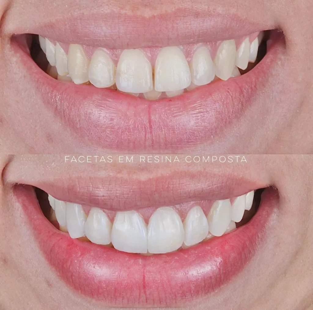 Facetas em Resina Composta | Antes e Depois