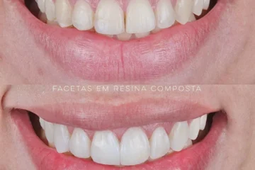 Facetas em Resina Composta | Antes e Depois