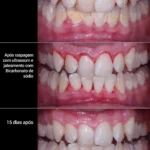 Periodontia | Consultório Dr. Bernardo Resende